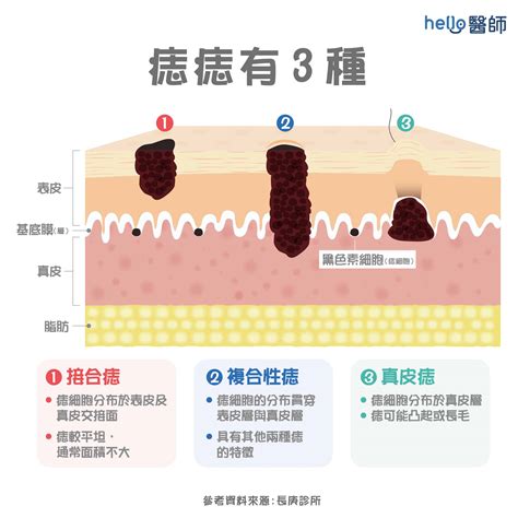 有毛的痣|痣變大、痣多或長毛會變皮膚癌？認識痣的形成與原因